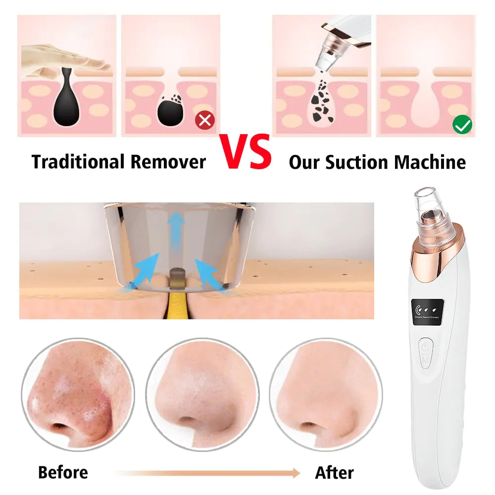 Blackhead Remover Vacuum Facial Cleaner